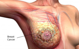 Breast cancer; A rising health problem in women. Know the causes and treatments
