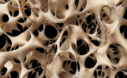 Five facts about Osteoporosis. Are women more affected by it?