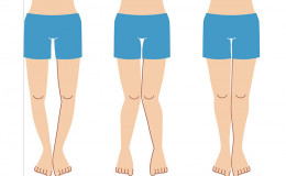 What is Knock Knees? Know about its Symptoms. Causes. and Remedies
