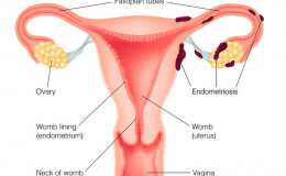 What is Endometriosis? Know about its Sign, Causes, and Remedies