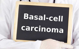  Basal Cell Carcinoma: See its Causes, Sign, Treatment and much more