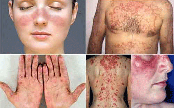What Is Lupus Know About Its Signs Symptoms Complications And Treatment
